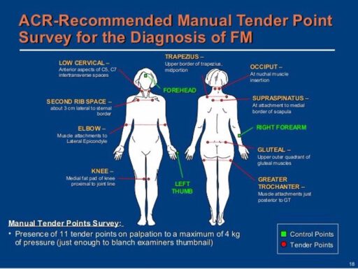 symptomen fibromyalgie