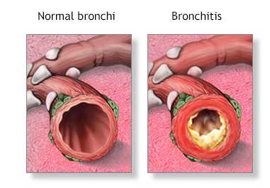 COPD bronchitis